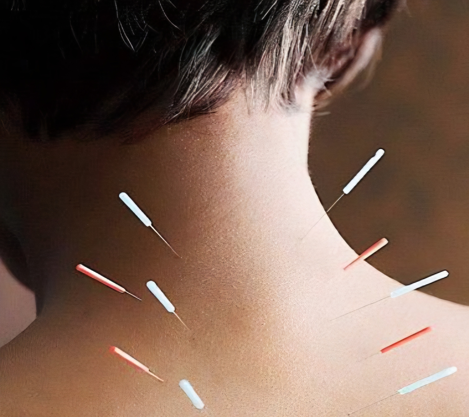 Dry Needling