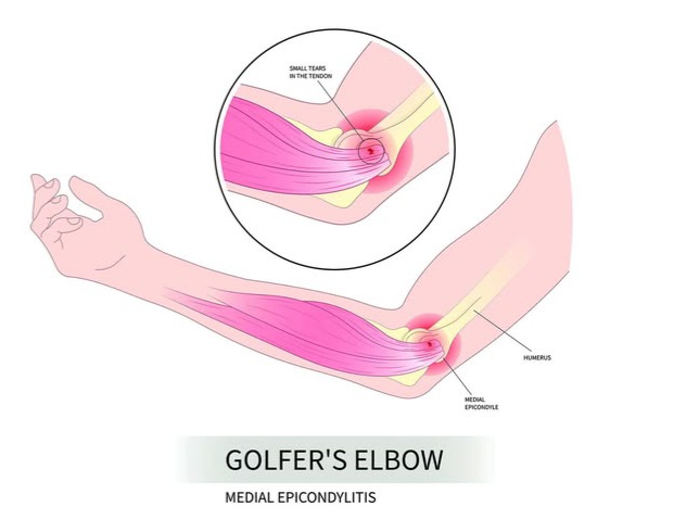 Golfer's Elbow