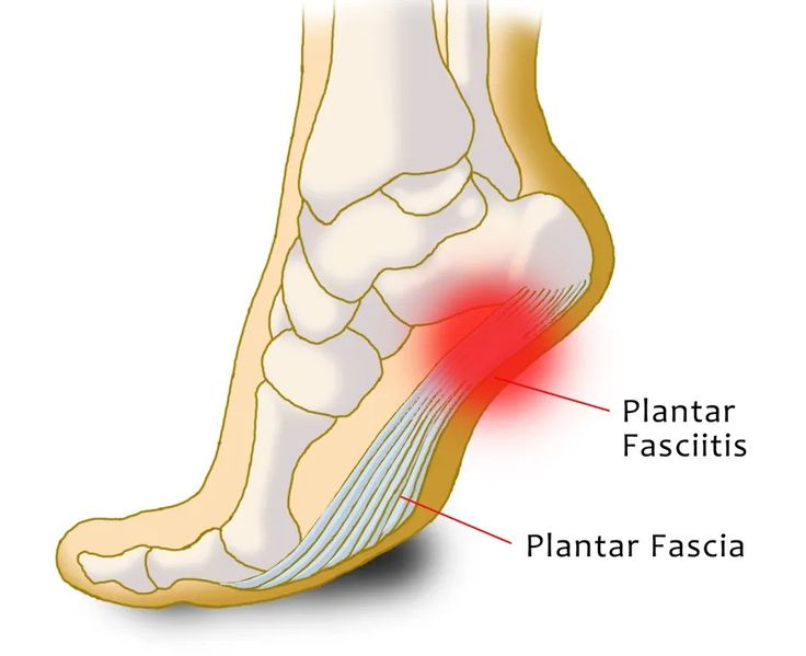 Plantar Fasciitis