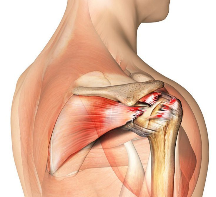Rotator Cuff Injury